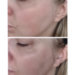 Vorher-Nachher Vergleich