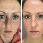 Boost Vorher-Nachhher Vergleich